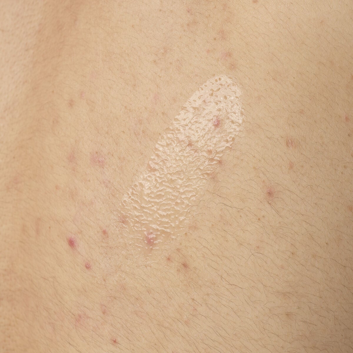 salicylic-acid-0-5-body-serum-g4 ORD-salicylic-acid-05-body-240ml-application.jpg