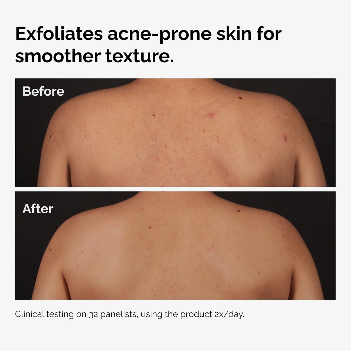 salicylic-acid-0-5-body-serum-g4 ord-salicylic-acid-body-serum-before-after-graphic-NA.jpg