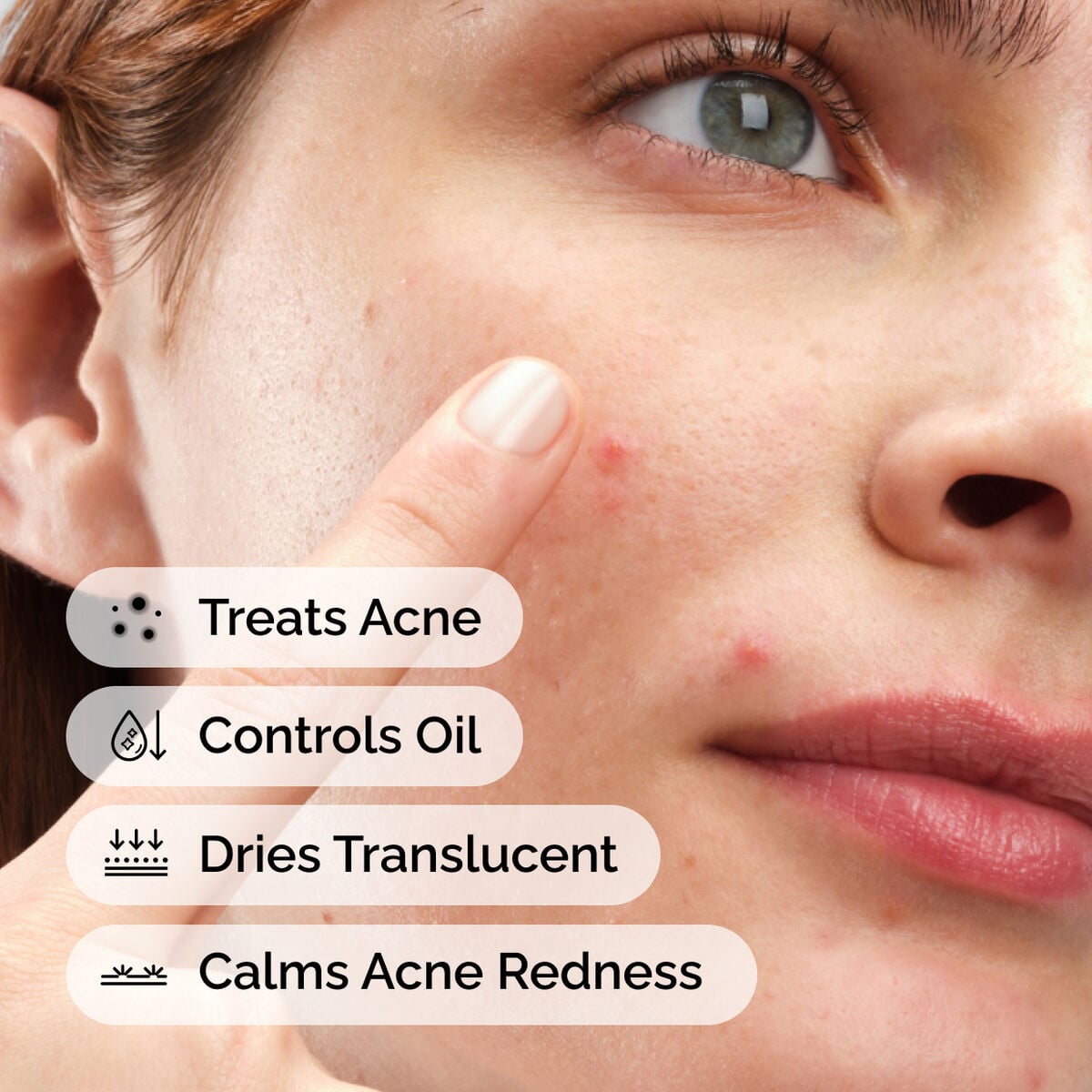 sulfur-10-powder-to-cream-concentrate-c6 ord-sulfur-10pct-powder-to-cream-concentrate-model-application-with-benefits-acne.jpg